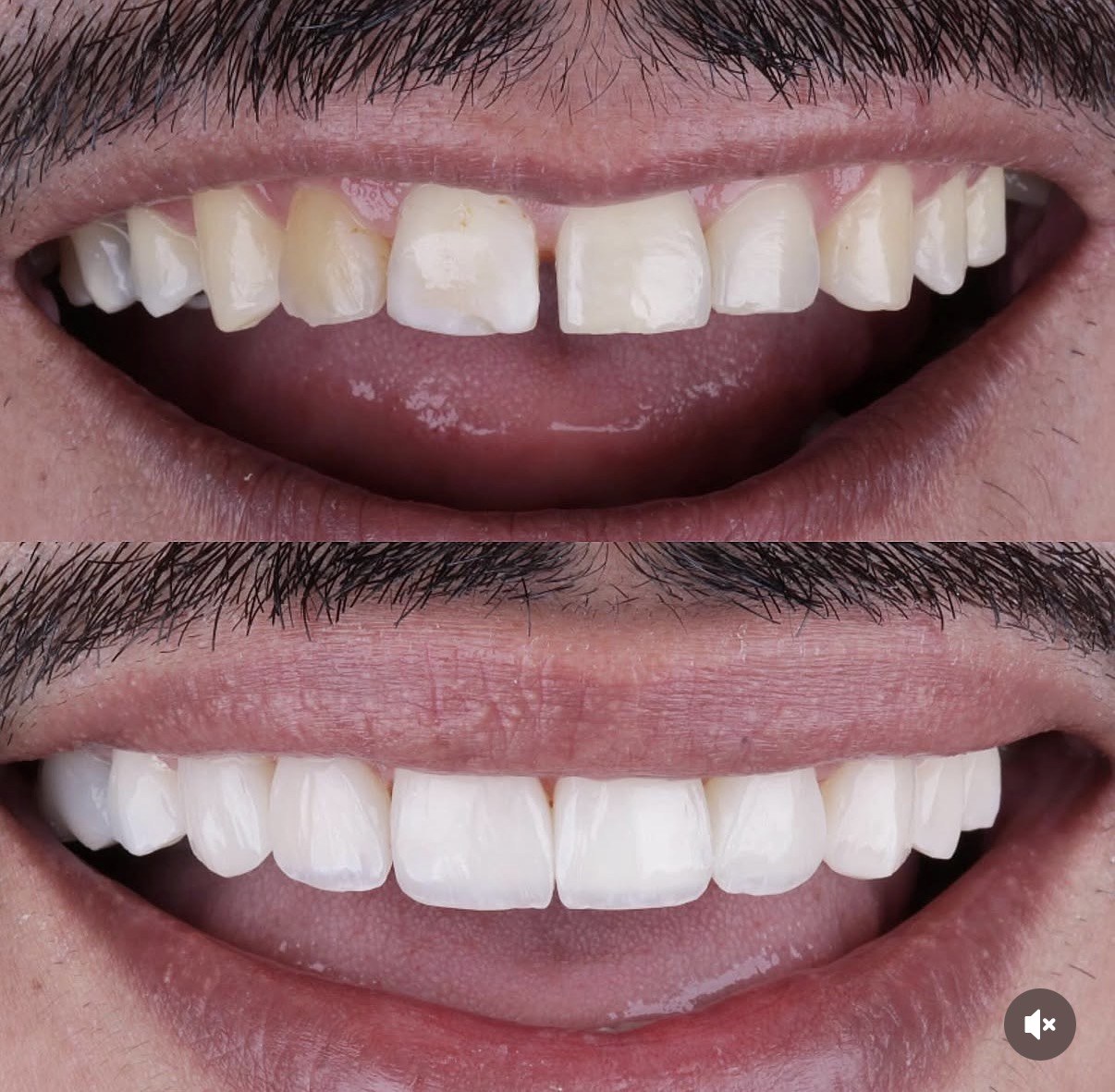 Resultado odontológico real apresentado pela Villa Sorriso